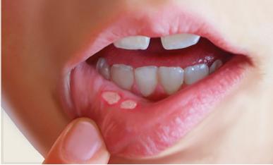 Aphthous Ulcers1 - Canker Sores, Mouth Ulcers, Aphthous Ulcers