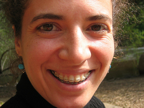 braces right for adults